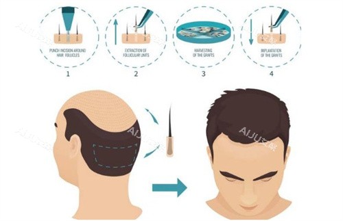 不同的植发类型 不同的植发类型