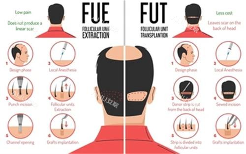 不同植发技术对比图解 不同植发技术对比图解