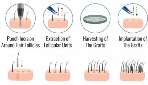 毛发移植过程图解 毛发移植过程图解