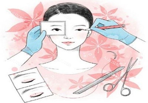 双眼皮手术示意图 双眼皮手术示意图