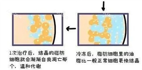 酷塑吸脂原理 酷塑吸脂原理