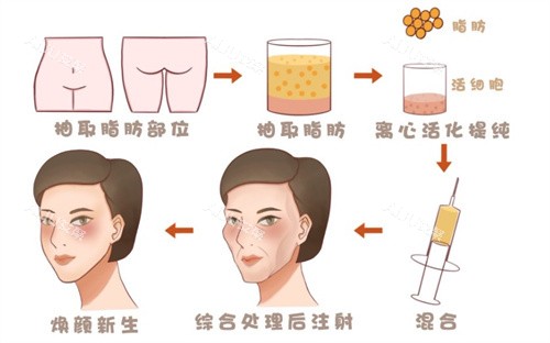 脂肪填充面部 脂肪填充面部