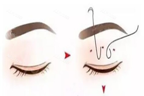 埋线双眼皮卡通示意图 埋线双眼皮卡通示意图