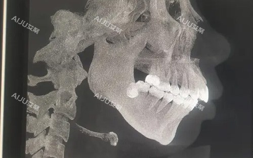 需要做正颌手术的骨骼图 需要做正颌手术的骨骼图