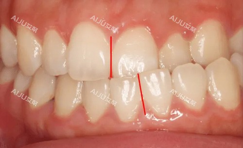 偏颌照片 偏颌照片