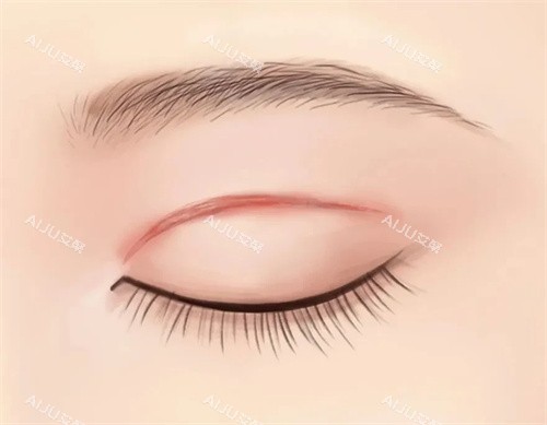 双眼皮的术后疤痕 双眼皮的术后疤痕