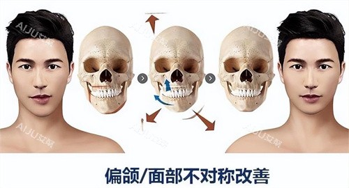 正颌手术原理与对比展示动画图 正颌手术原理与对比展示动画图