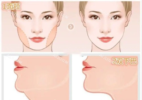 面部吸脂示意图 面部吸脂示意图