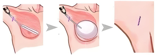 假体隆胸术图 假体隆胸术图