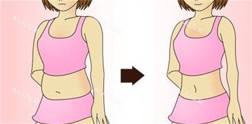 吸脂瘦身前后对比 吸脂瘦身前后对比