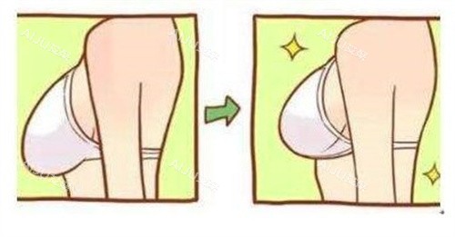 隆胸手术对比 隆胸手术对比