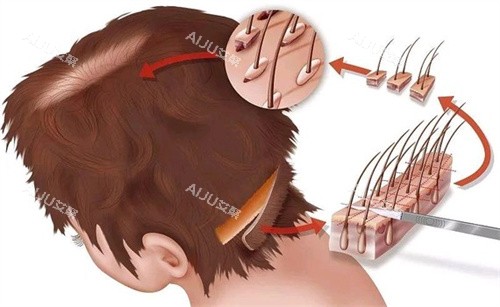 毛囊移植部位演示图 毛囊移植部位演示图