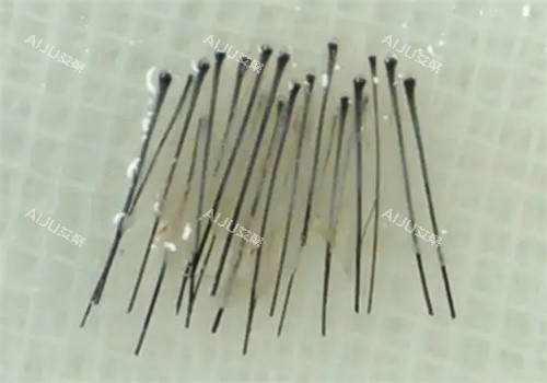 毛囊处理照片 毛囊处理照片