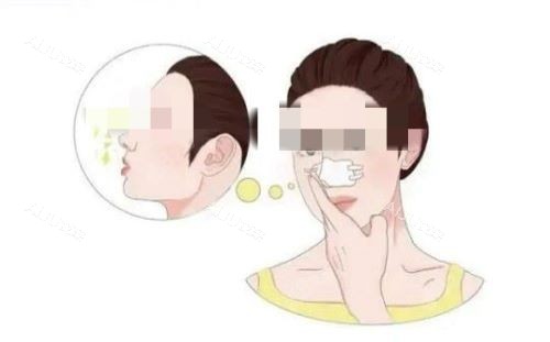 隆鼻术后展示图