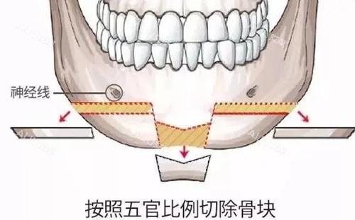 下颏T型截骨示意图