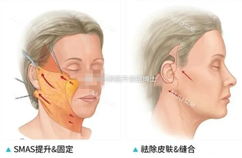 袁强博士面部提升术