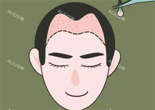 M型发际线种植