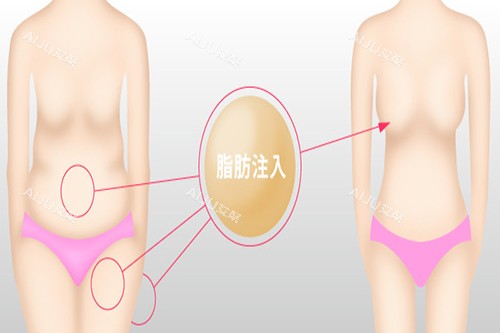 脂肪隆胸示意图5