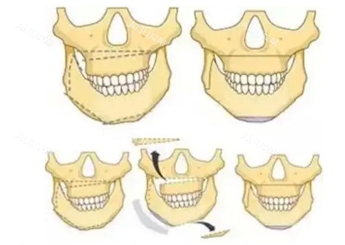 正颌手术卡通照片 正颌手术卡通照片