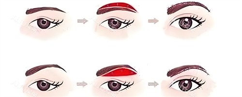 常规提眉手术步骤动画演示图 常规提眉手术步骤动画演示图