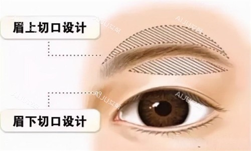 提眉手术切口动画演示图 提眉手术切口动画演示图