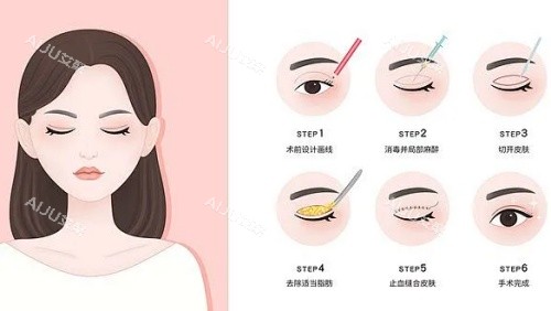 邯郸李婷整形眼部整形示意图