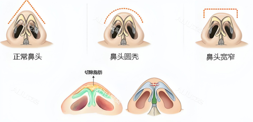 鼻翼缩小种类