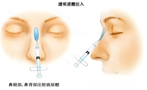 隆鼻骨胶原注射图