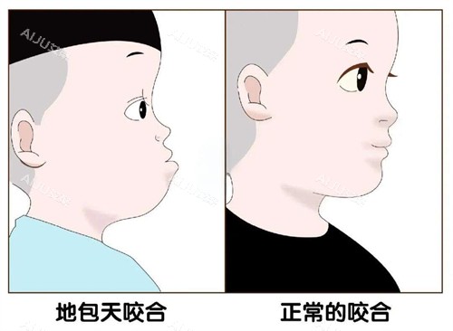 地包天和正常对比图