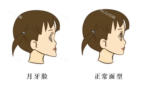 地包天示意图