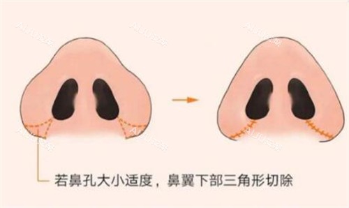 鼻翼缩小改善照片