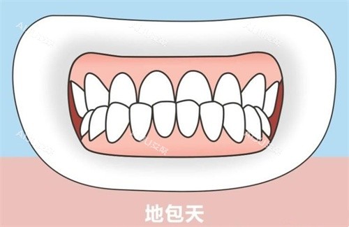 地包天示意图