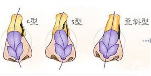 唇腭裂鼻子坍塌 唇腭裂鼻子坍塌