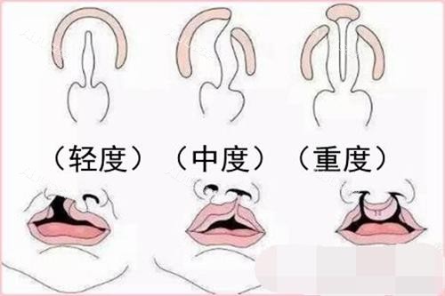 唇腭裂示意图 唇腭裂示意图