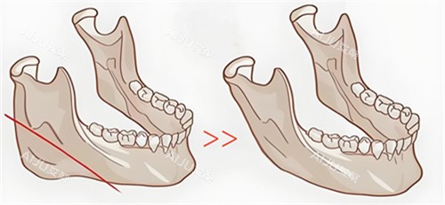 下颌骨切除步骤动画演示图 下颌骨切除步骤动画演示图