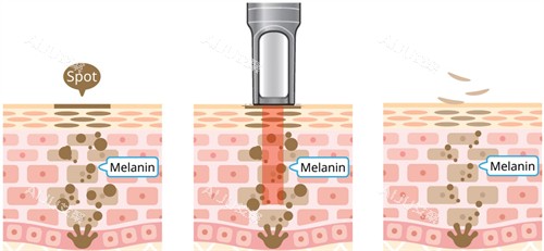 激光改善面部斑点 激光改善面部斑点