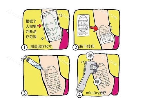 miradry微波治疗的过程图 miradry微波治疗的过程图