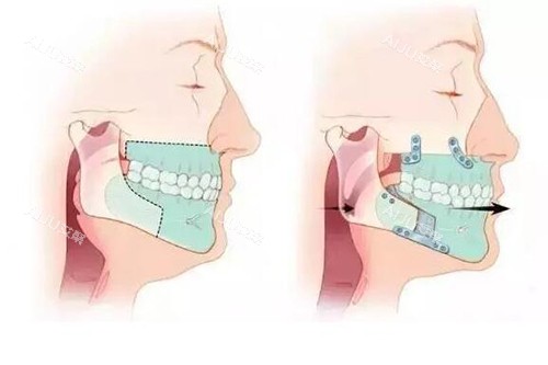 正畸正颌联合治疗 正畸正颌联合治疗
