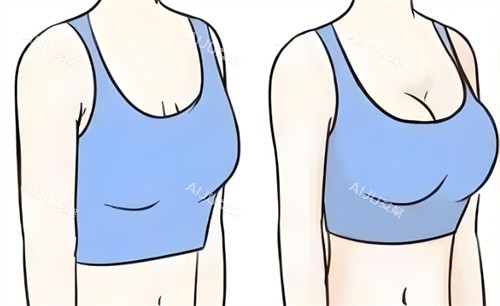 隆胸前后对比 隆胸前后对比