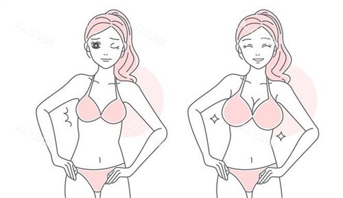 隆胸手术前后 隆胸手术前后