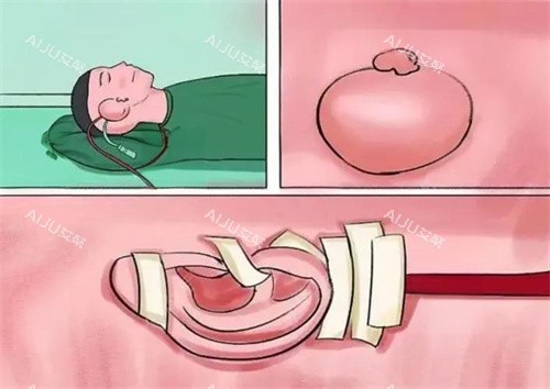 扩张器法耳再造手术演示图 扩张器法耳再造手术演示图