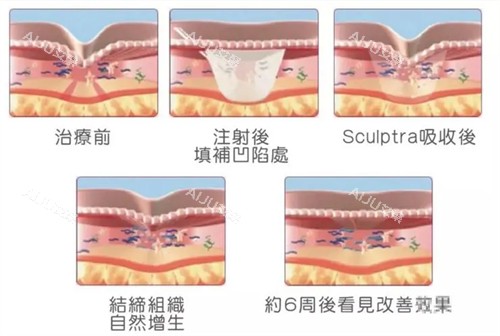注射童颜针后皮肤的变化周期 注射童颜针后皮肤的变化周期