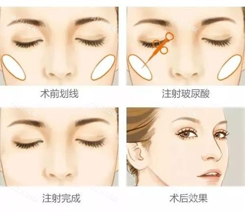 玻尿酸前后注射示意图 玻尿酸前后注射示意图