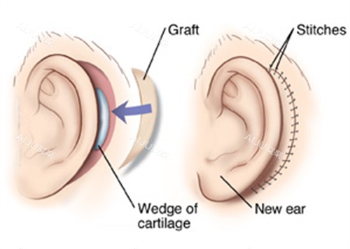 耳再造手术的切口 耳再造手术的切口