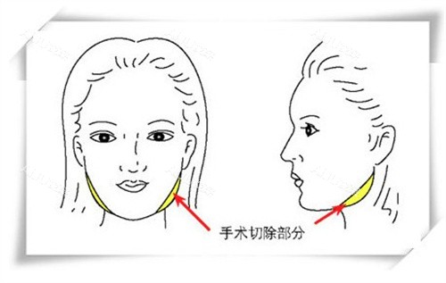 peek下颌角修补