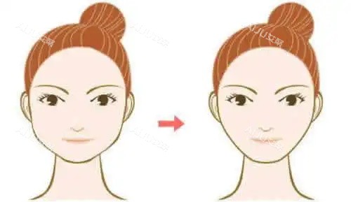 下颌缘提升对比图