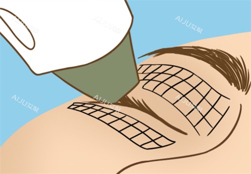 热玛吉眼部抗衰过程图解 热玛吉眼部抗衰过程图解