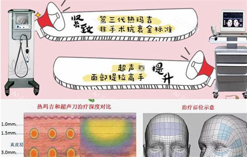 热玛吉与超声仪器抗衰的作用图解 热玛吉与超声仪器抗衰的作用图解