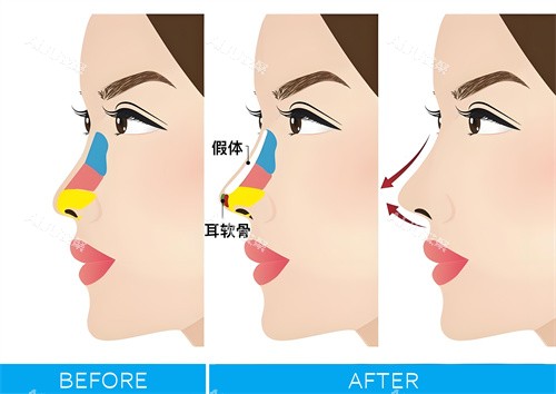 广州新市整形吕方中隆鼻手术图解动画图