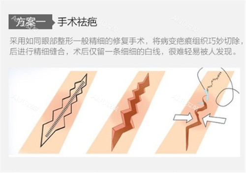 祛疤膏原理图